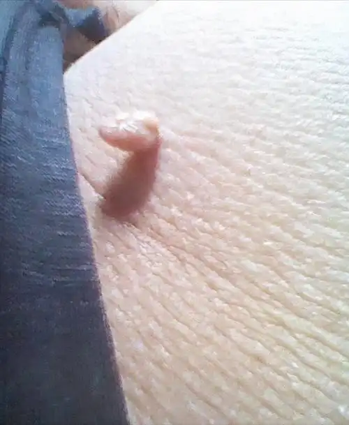 上文中的女士出现的就是丝状疣,它的颜色和皮肤颜色相近,手感非常柔软