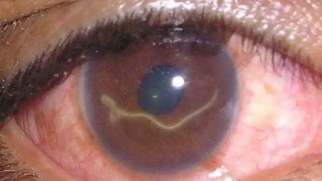 这个寄生虫在显微镜下看来普通,但当他出现在人的眼