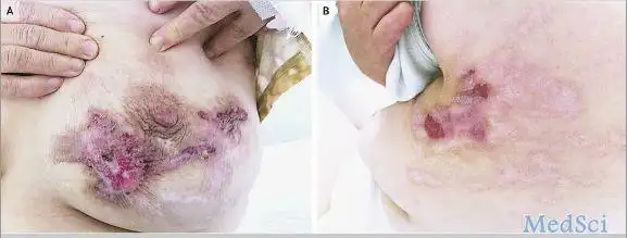 几例罕见"梅毒"案例报道