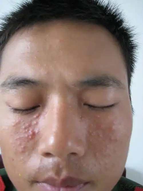 大家看看是否为痤疮