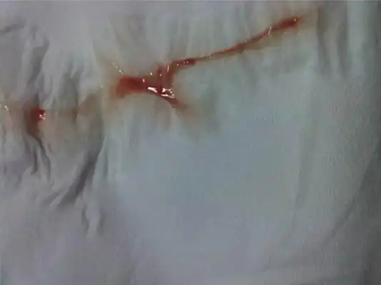 白带带血图片49