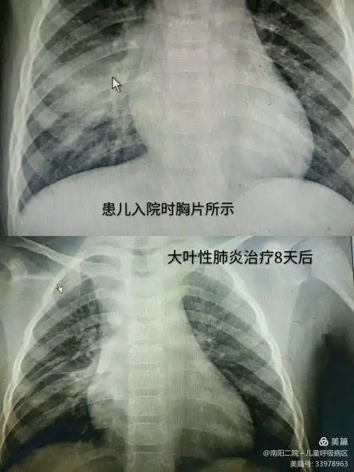 男,3岁,因"发热,咳嗽4天"为主诉入院,入院后完善胸部ct提示大叶性肺炎