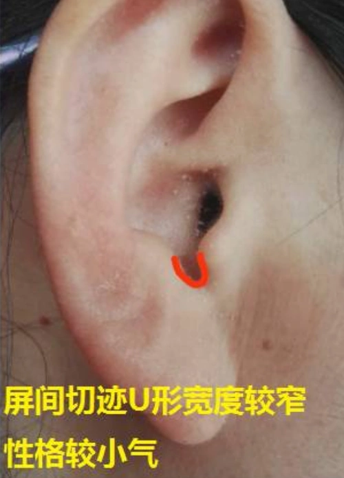 如下图:屏间切迹定义:耳屏和对耳屏之间的凹陷处,近似一个u形(如下图