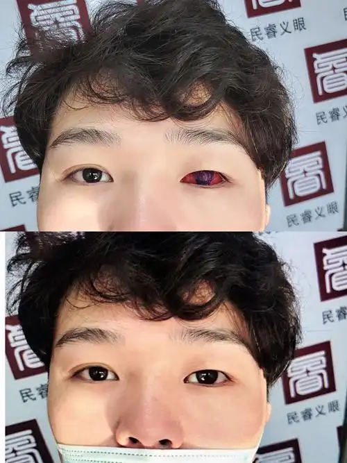 民睿义眼客户案例-眼科仪器案例-上海民睿医疗器械有限公司