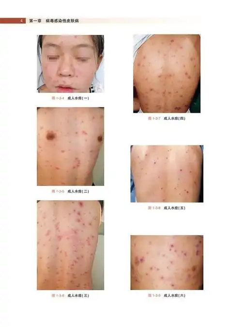 1749名村医都在看的皮肤病性病图谱,赶紧学起来!