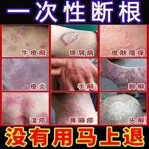 卡泊三醇软膏 15g*1支/盒 寻常型银屑病 外用牛皮癣药膏 爱尔兰利奥