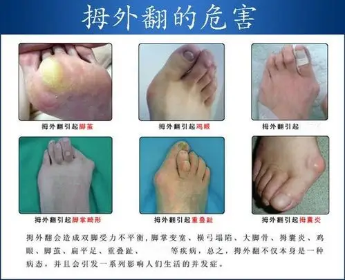 汝州市一处医院–微创治疗踇外翻