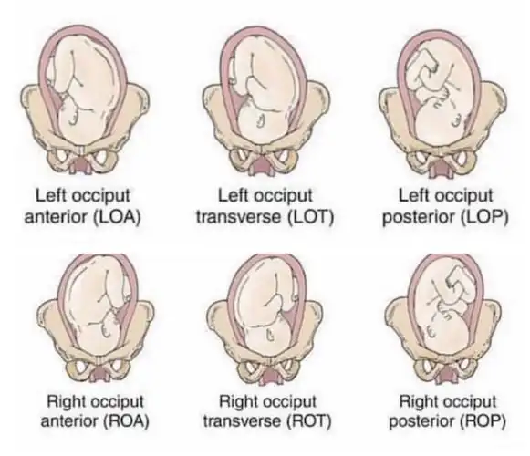 原来胎位有20多种,哪种最适合顺产呢?