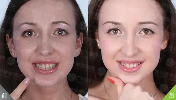 俄罗斯名模冷光美白牙齿前后对比(组图)