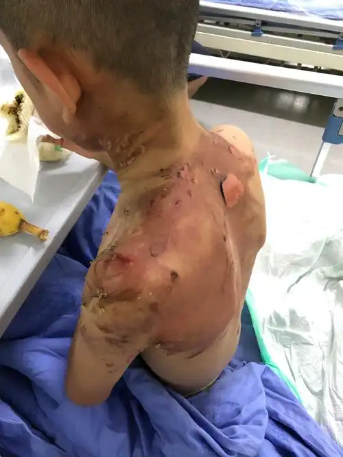 六一儿童节火锅店大面积烫伤儿童商家拒绝支付后期医疗费用