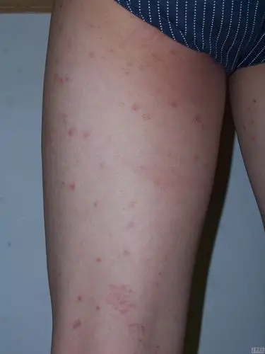 【求助】我得的是哪种皮肤病?(新上传图片及病理图片)