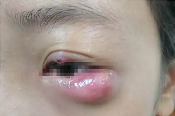 眼疖子严重了的图片