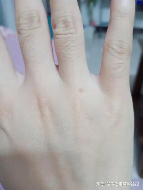 痣长在右手背有什么含义