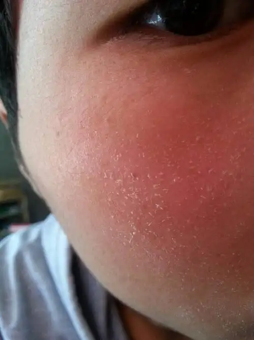 我皮肤总是这样干燥,有时候抹一下还有许多小壳.要怎么办?