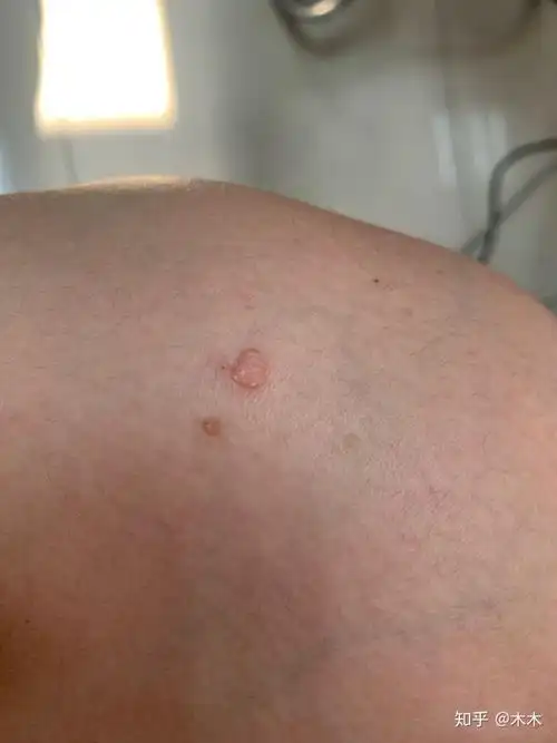 腿上长了一个小肉瘤,好几年了,会慢慢变大
