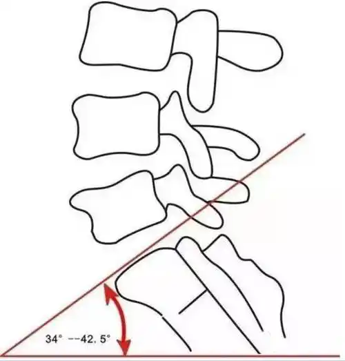 正常腰骶角平均为130°,l5椎体指数为90°,当腰椎退变滑脱时,腰骶角和