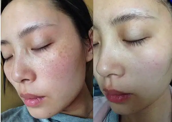 祛斑前后的对比照