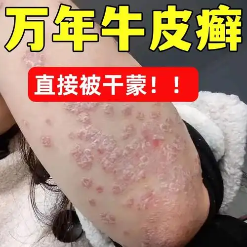 皮肤痒止痒膏特效打折-淘宝特价-优惠活动-券站长