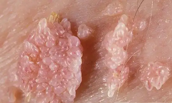 男性好发于包皮,龟头,冠状沟,系带,阴茎,尿道口,肛周和阴囊等部位