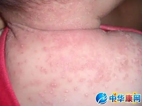 万事顺意! 湿疹图片初期症状图 "云锦山前炼大丹"-第1张图片-南皮博客