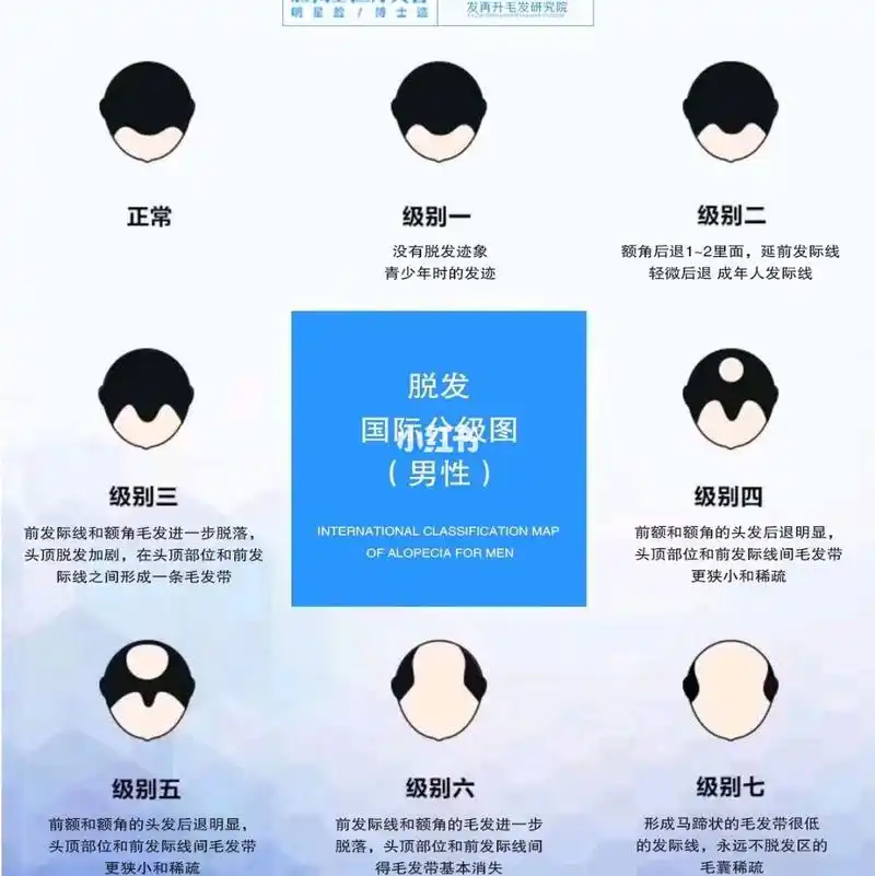 【脸博士植发中心】 看下面这张男性脱发分级图,您就知道自己现在是