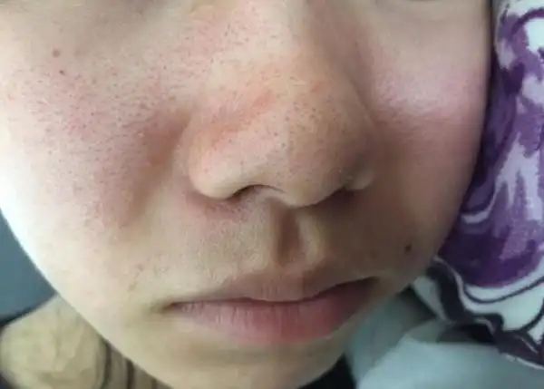 黑头白头在显微镜下是这样的导致你的毛孔大