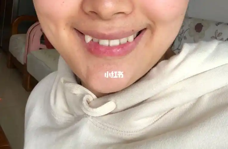 大尖虎牙!要箍牙吗!纠结!_牙套_生活记录_日常片段_日常片段其他