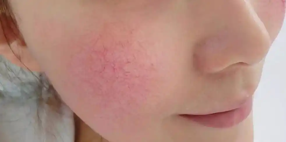 女人护肤时,皮肤"刺痛"千万不能忍!教你几招避免皮肤问题恶化