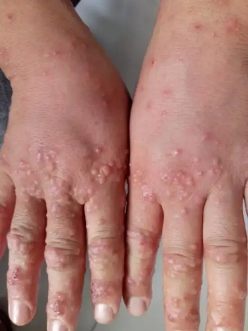 15年庆《全科医师皮肤病看图诊断》——丘疹,疱疹,微痒(5)