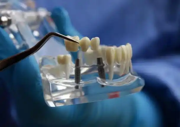 对种植牙应当集采与限价双管齐下_财富号_东方财富网