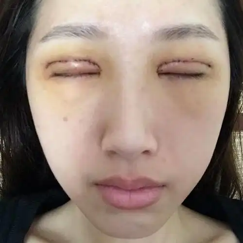 刚割了双眼皮