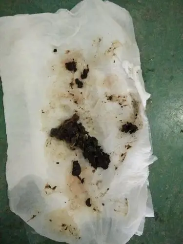 我的朋友在用百福丹治疗妇科炎症用完后下面排出一些类似于肉的东西