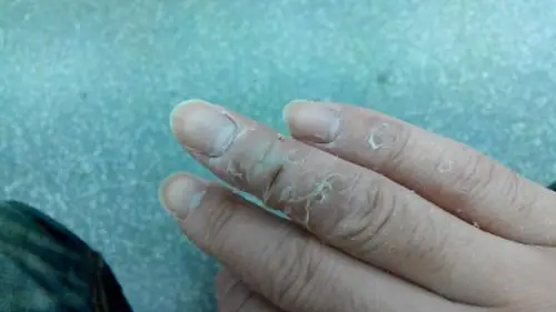 这是湿疹,脚藓,过敏性皮炎,还是湿气重?天天泡醋精没用__kds宽带山