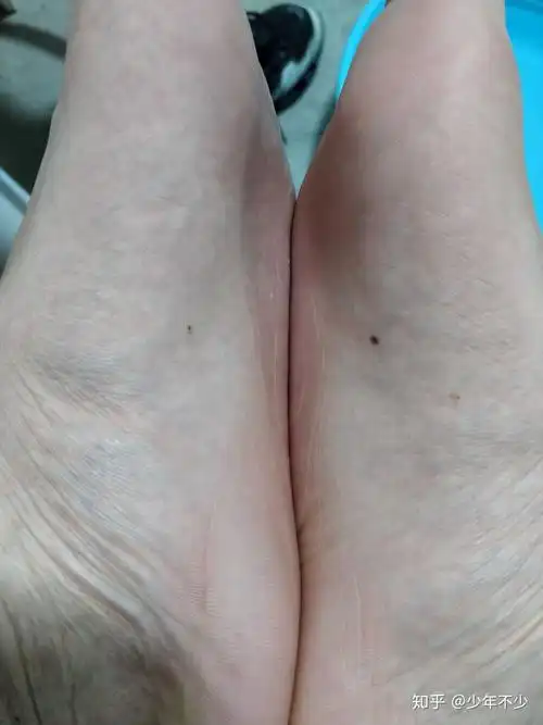 脚底板长了一颗痣? - 知乎
