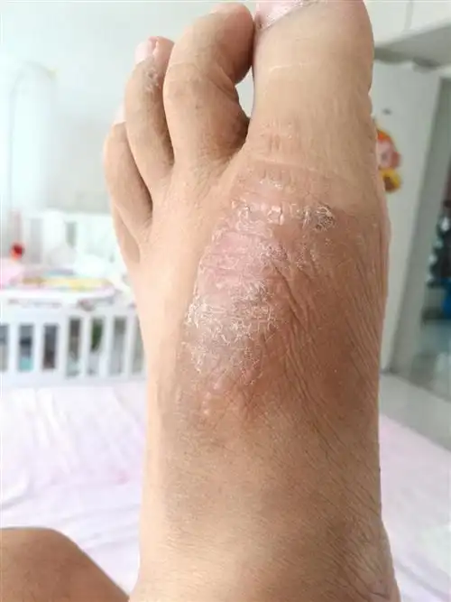 向医生提问皮炎别名:发病部位:并发疾病热门问答过敏性皮炎症状是什么