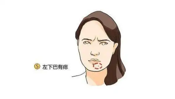 传说中的"发财痣",身上有一颗,注定财运大发,看看你有吗?