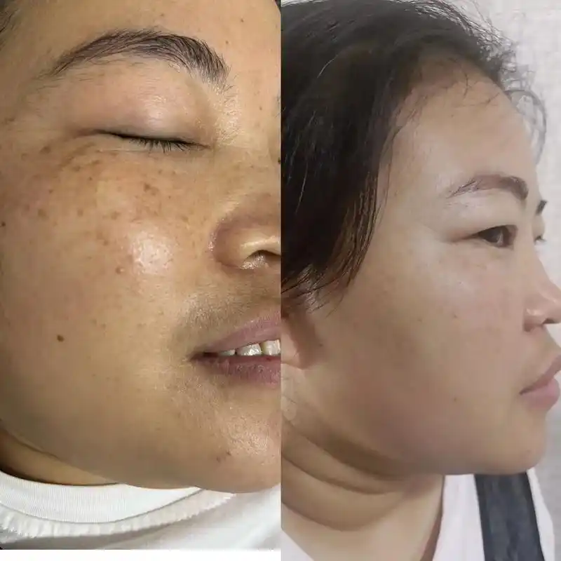 雅诺祛斑一次九天的效果,无美颜无滤镜哈#美白淡斑 #前后对比 - 抖音