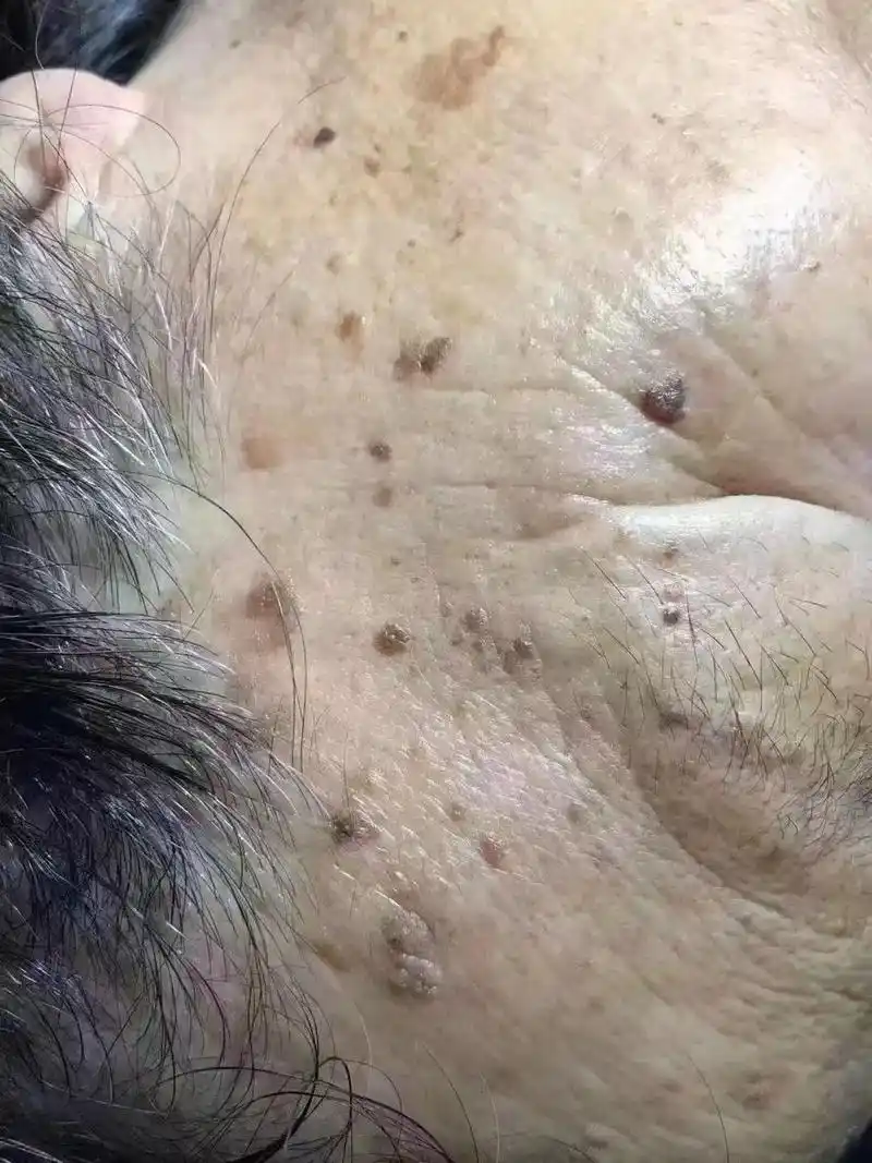 扁平疣具传染性