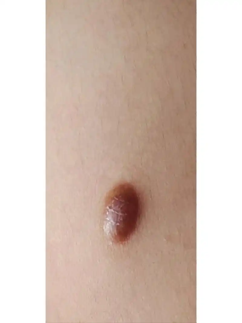 手臂上长了一个肉疙瘩,是个啥 摸上去硬硬的,用针戳也不流血,里面还有