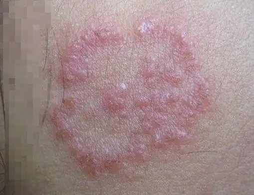 体股癣初期现象图片8