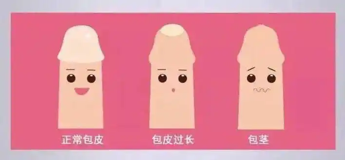 2手术治疗 一般情况下,患包茎的小儿可在三四岁后手术治疗,如果炎症