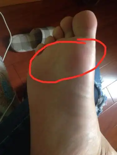 右脚掌走路疼好个2 3天之后又会犯一疼起来右脚走路就不好走 感觉脚底