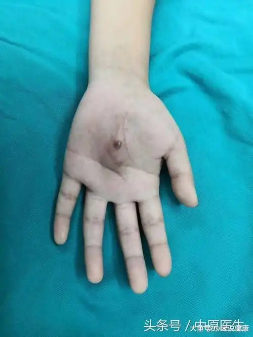 15岁女孩手掌里长肿瘤三次到医院切除, 真不是练太极练出来的