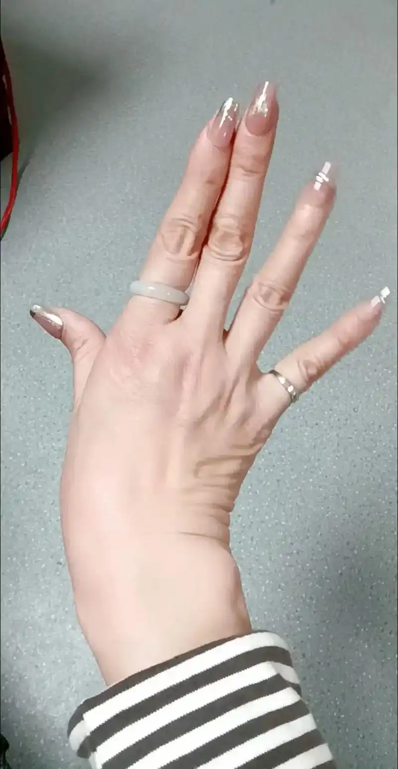 马凡氏综合症病人的大手,是不是有种病态美98#一起举个爪 # - 抖音