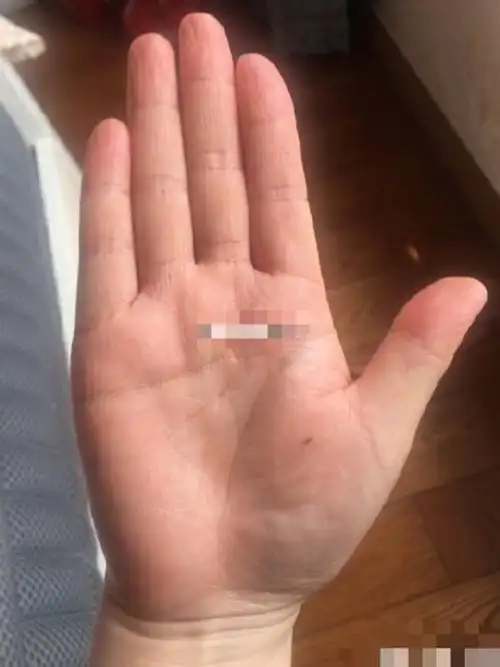 从手相来看,金星丘有痣,说明早年家境较好,或父母保护的比较好,少年