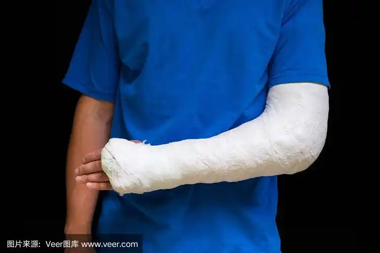 手臂骨折的男子身上裹着医用石膏.