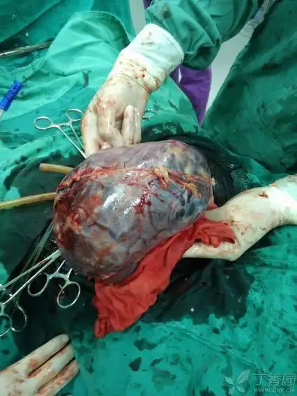 给你们看个胎盘植入吧. [病例帖]