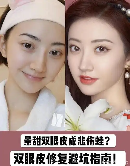 景甜双眼皮成悲伤蛙?双眼皮修复避坑指南!