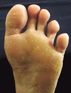 脚痒脚臭和掉皮每次脱了鞋子满屋恶臭脚每天早上很干到晚上