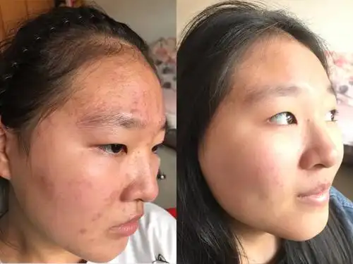 脸上痤疮用药前后痤疮形成的4点原因1,皮脂腺异常活跃出油增大,大量的